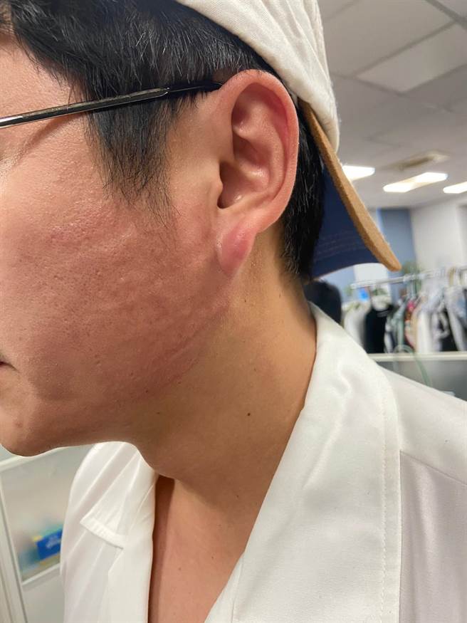 黄靖伦被呼巴掌后留下红肿掌印。（TVBS提供）