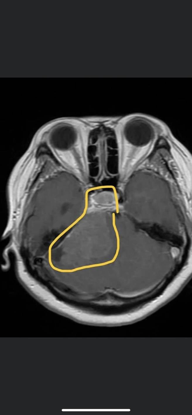 陳姓患者除有「水腦症」，另腦部深處有7公分大「小腦橋腦角腫瘤」合併腦幹壓迫。（長安醫院提供／張妍溱台中傳真）
