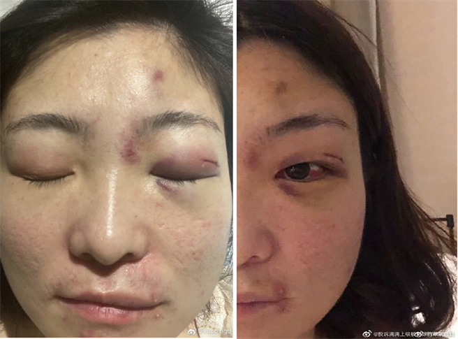一名自称是前滴滴女员工的单亲妈妈在微博贴文控诉，因工作关系被滴滴公司主管强迫参加饭局，并在饭局后到侵犯，经向公司控诉后反被公司开除。图为她在微博上贴出当时被迷奸醒来时脸部多处受伤的照片。（图／微博)