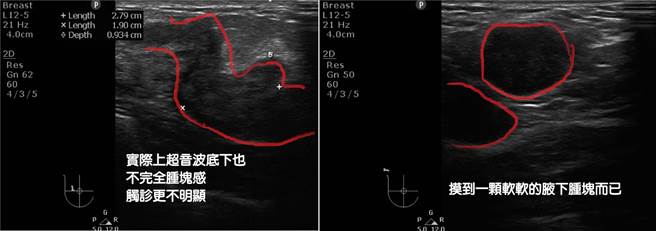 一名女性打完莫德纳后，右边腋下出现肿胀感，医师替她照超音波检查。（图／翻摄自杏妍诊所粉专）