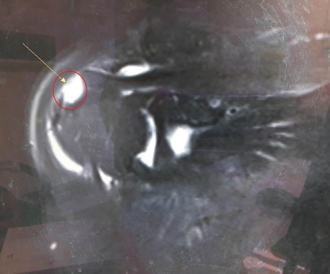 旋转肌肌腱破裂(红圈箭头处)是因外伤或长期磨损退化造成，需依赖医师经验及核磁共振检查来确诊。（大千医院提供／谢明俊苗栗传真）