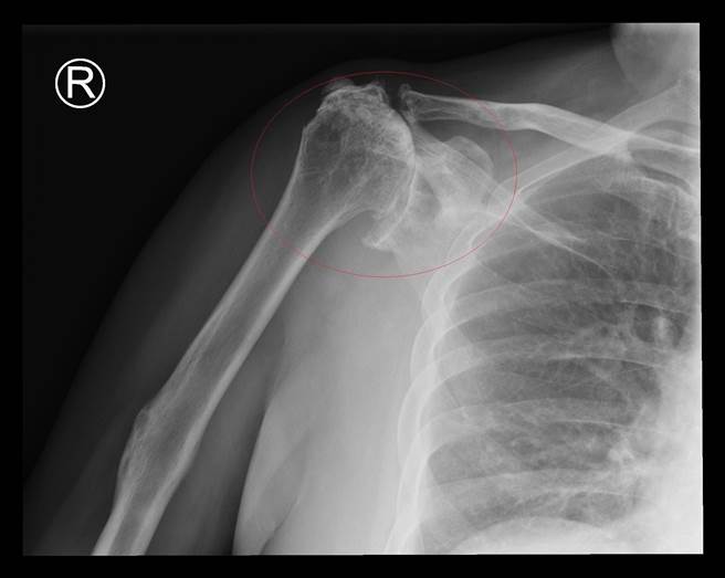 许翁右肩的旋转肌全破，骨头偏移磨损。（彰化医院提供／吴建辉彰化传真）