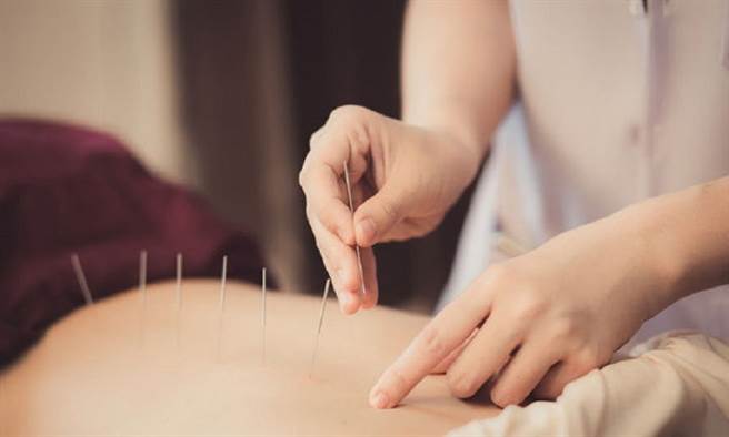 浮针的发明源自于传统针灸。 (图片来源 / Shutterstock)