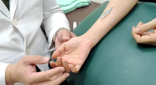 浮针是横面下针，以扫散手法纾缓肌筋膜。(图片来源/中国医药大学附设医院)