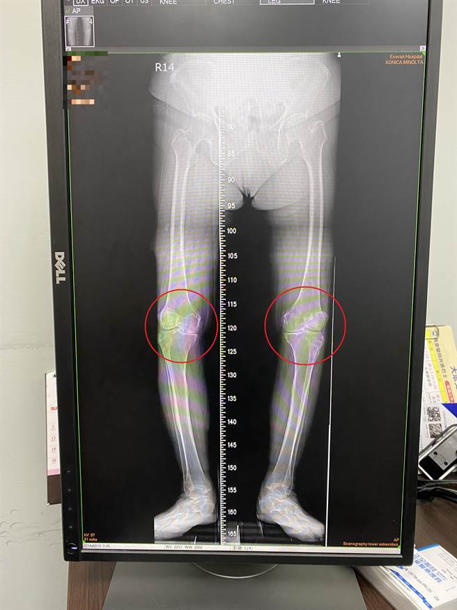 87岁吴阿嬷两脚膝关节处间狭窄，常常痛到难入眠。（长安医院提供／张妍溱台中传真）