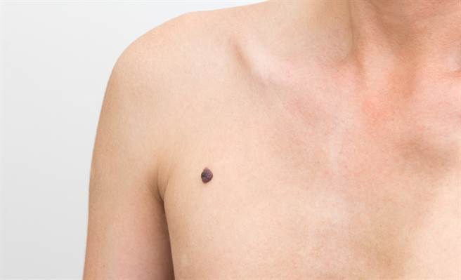 一名男子胸口突长黑痣，且还会变大、红肿，就医后发现原来是一颗壁虱。（图／示意图，达志影像）