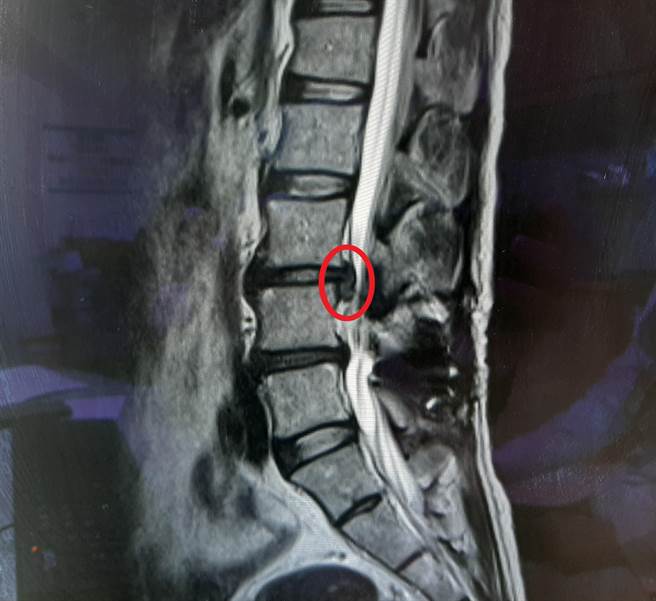 李姓民眾因嚴重腰椎椎間盤脫疝(紅圈處)導致左腿疼痛無法行走。（大千醫院提供／謝明俊苗栗傳真）