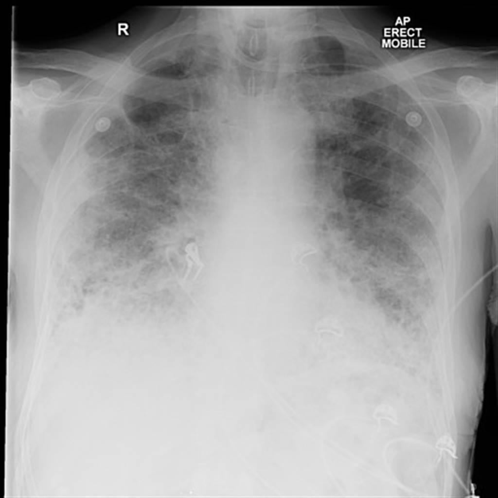 肺部纤维化患者的肺部出现很多疤痕组织，在X光下形成白雾状。图/radiopaedia(photo:ChinaTimes)