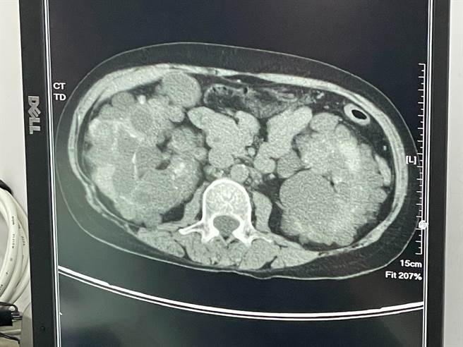 50岁张姓女患者，罹患多囊肾病变而造成尿毒症，9年前至中荣接受肾臟移植评估，接受血型不相容活体肾臟移植手术。（中荣提供／张妍溱台中传真）