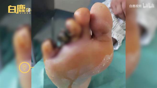 大陸一名男子近日發現腳趾發黑急忙就診，醫生檢查後指出因為他長期抽菸導致血管堵塞，最終引發腳趾缺血壞死。(圖/翻攝自白鹿視頻)