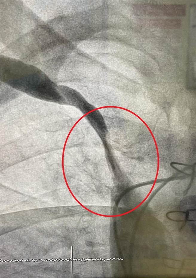 黄爷爷中心静脉血管狭窄(红圈处)，每次洗肾时手臂会疼痛，无法顺利完成治疗。（大千医院提供／谢明俊苗栗传真）