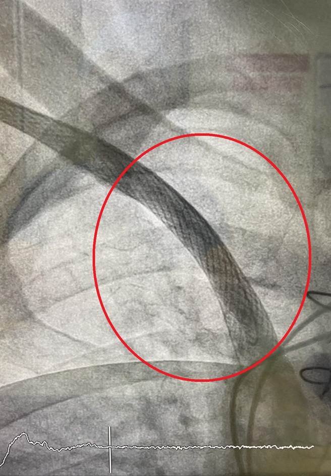 在接受中心静脉支架手术后，顺利解决让黄爷爷的血管恢復通畅(红圈处)。（大千医院提供／谢明俊苗栗传真）