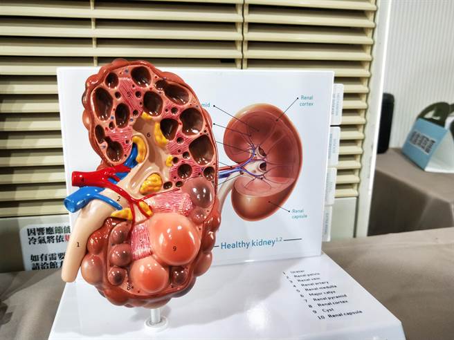 多囊肾患者的肾臟会长出水泡，因此又称为「泡泡肾」，由于压迫到正常肾臟组织，影响肾功能而逐渐走向洗肾。（王家瑜摄）
