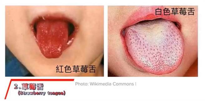 感染新冠病毒，约有四分之一的患者会出现口腔病灶，像是舌头变红、变肿、出现红斑或是点状草莓舌。(图/取自蔡逸姗医师粉丝页)