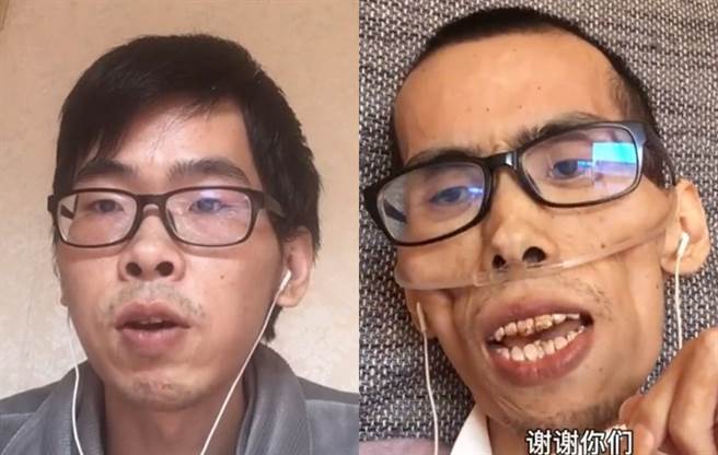 34岁网红阿健因直肠癌病逝。（图／西瓜视频@阿健要努力活着）