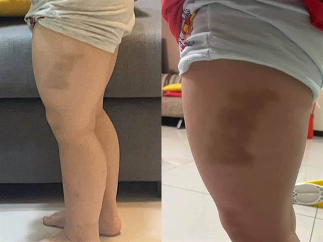 该母亲说当天孩子下课后回家洗澡时，身体并无异状，但2个小时后就出现瘀青，质疑校方不当对待。（翻摄自脸书「爆怨公社」）