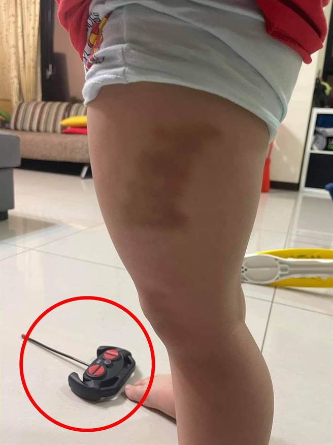 有人认为孩子的瘀青与照片中的「玩具遥控器」形状极相似，怀疑根本竟只是孩子自己压到。（翻摄自脸书「爆怨公社」）