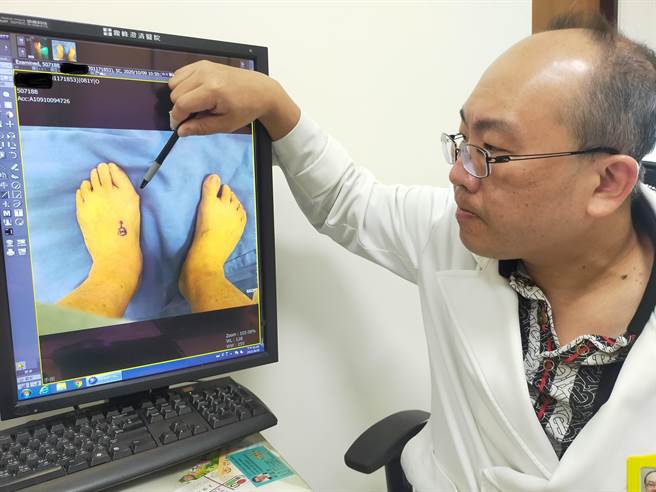 台中市雾峰澄清医院医疗副院长林劭颖指出，拇趾外翻有一定比例来自遗传及扁平足，轻症者可採保守治疗。（冯惠宜摄）