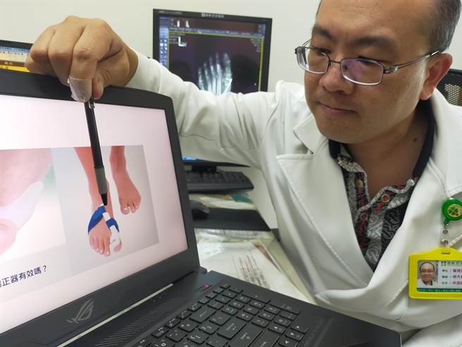 雾峰澄清医院医疗副院长林劭颖指出，拇趾外翻角度小于20属于轻度，通常採保守治疗，矫正器理论上无法使角度变小，只能舒缓疼痛。（冯惠宜摄）