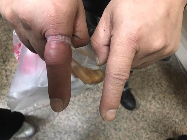张男手部遭钢制戒指套牢长达4天，食指肿胀、发紫。（陈彩玲摄）