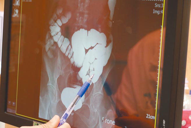 台中慈濟醫院邱建銘主任說明便祕病人腸道呈現彎曲形狀。（台中慈濟醫院提供／陳淑娥台中傳真）