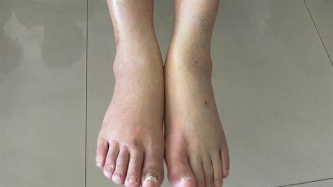 一名女网友近日在网路分享爷爷的双腿照，没想到照片曝光后，一票网友却提醒她注意爷爷身体状况，并直言「可能肾臟有问题」。（图／翻摄自Dcard）