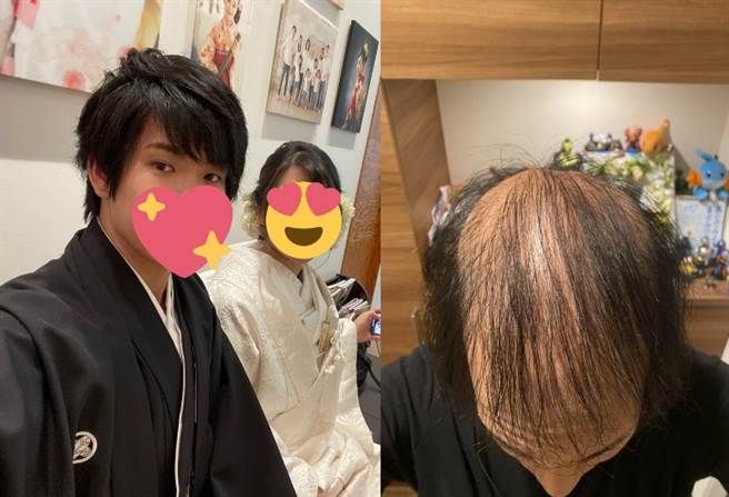 日本男网友打完莫德纳疫苗，73天后大量头髮脱落。（图／翻摄自Twitter）