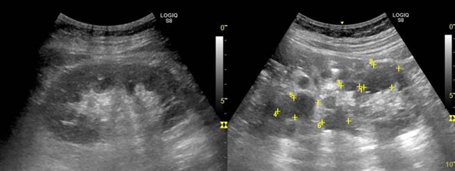 超音波比对正常健康的肾臟(左图)；24岁多囊肾患者肾有水泡(黄点处)外观变形(右图)。（光田综合医院提供／王文吉台中传真）