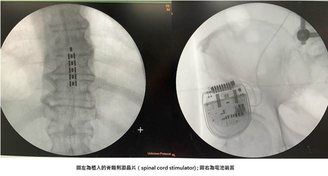 「脊髓刺激晶片疗法」是将晶片植入于脊髓，传送微量电流刺激神经系统，阻碍痛觉讯号传递。（长安医院提供／冯惠宜台中传真）