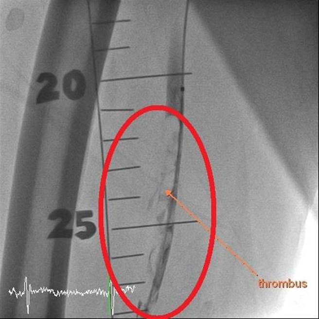 陈姓老翁右脚动脉被血栓塞住，大腿以下完全没有血流。（大千医院提供／谢明俊苗栗传真）