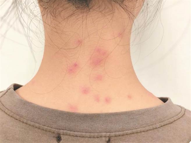 澎湖县卫生局疫调发现，短短一周内陆续接获上百例通报，病患出现大面积皮肤发疹红肿，大多分布在后脑杓、颈部、手臂、肚皮、后背等部位，患处出现一红色小疹子，搔痒难耐。（陈可文摄）