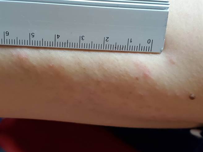 病患患部照片。(鸟屿卫生所提供／林雅惠高雄传真)