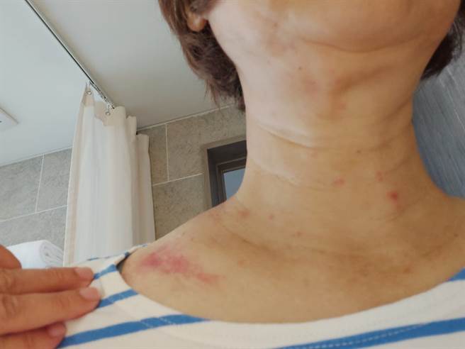 澎湖傳出紅疹怪病，家醫科醫師李佳燕一行人也中鏢，她根據經歷與病症，認為感染源並非毛毛蟲剛毛那麼單純。(圖／李佳燕臉書)