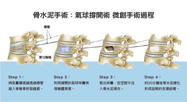 使用气球辅助，再灌骨水泥。（图片来源：Kyphoplasty | Rehab My Patient）