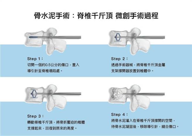 用千斤顶置入，再打骨水泥的驼背成形术。（图片来源：Neurochirurgia na światowym poziomie! | Carolina Medical Center）