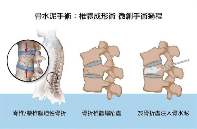 单纯打骨水泥。（图片来源：VERTEBROPLASTY – PARDISNOOR Medical Imaging Center）