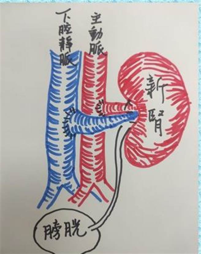 许、李小妹妹接受肾臟移植示意图，2人各获1.3个月大男童捐赠的一颗肾臟。（北荣提供）