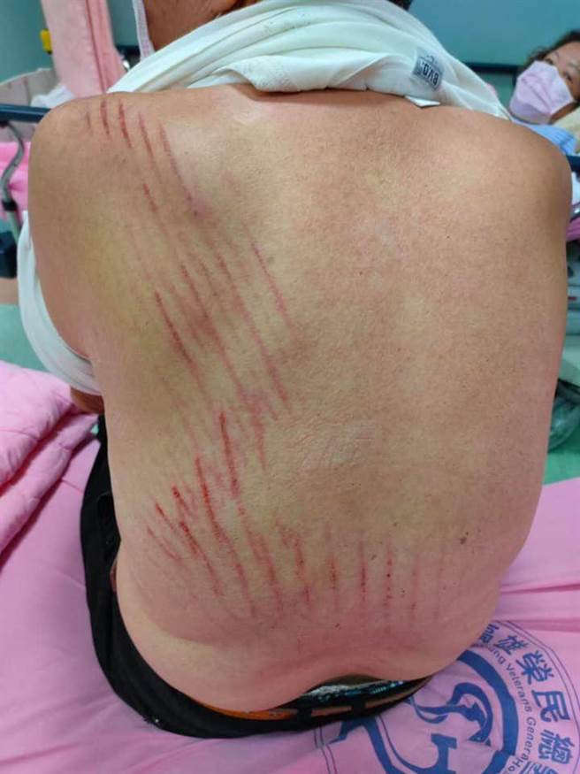 高雄市80多岁的夫妻在台铁新左营站搭手扶梯时，遭前方男子转身推下楼，老翁背部满身伤痕，家属指控台铁冷处理。（翻摄刘姓男子脸书／石秀华高雄传真）