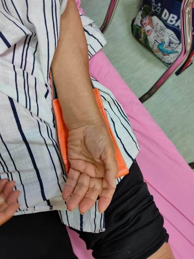 80多岁的夫妻中的妻子跌落台铁新左营站的手扶梯后，左手骨折。（翻摄刘姓男子脸书／石秀华高雄传真）