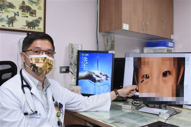王士忠表示，「视网膜母细胞瘤」是罕见的儿童眼部癌症，小朋友的瞳孔会像「猫眼」般折射光线。（图／彰基提供）