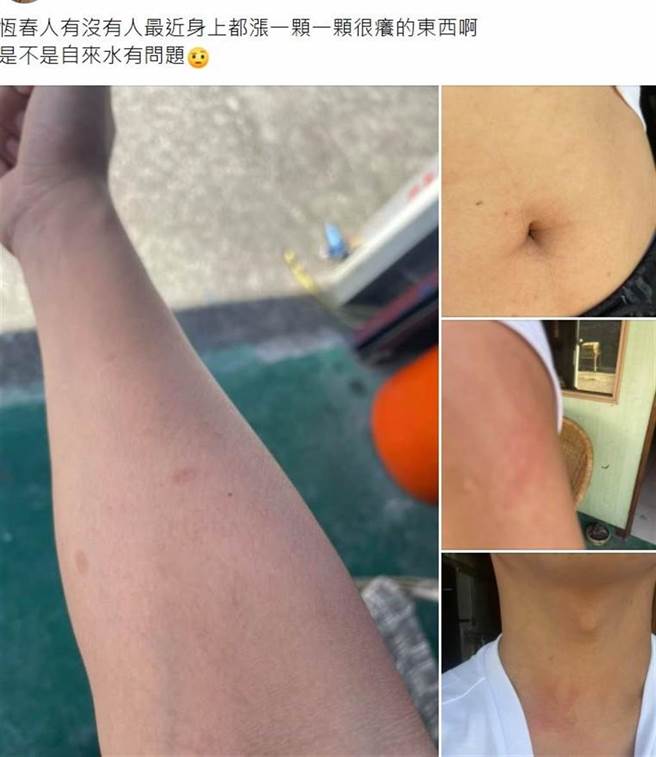 澎湖日前爆發「多人紅疹搔癢」現象，不料近來恆春半島也有多數民眾甚至是遊客出現紅疹發癢狀況。（民眾提供／謝佳潾屏東傳真）