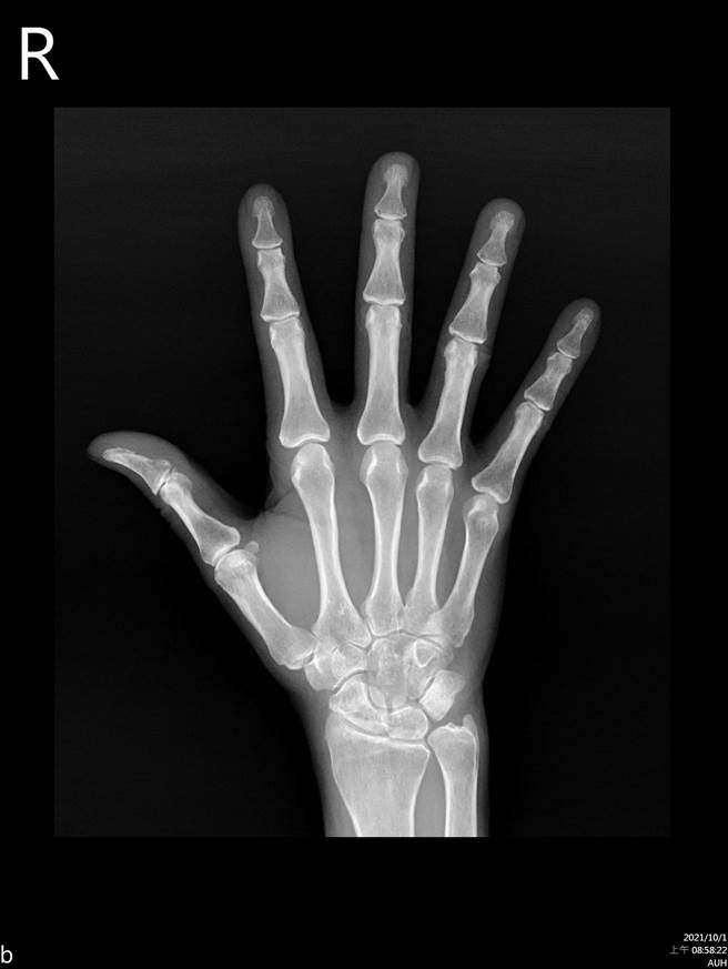 因患者發病後及早治療，故手指關節仍能正常活動。此為患者手部X光影像。(亞大醫院提供／林欣儀台中傳真)