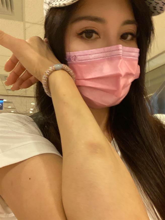 杨丽菁无端被打到瘀青。(经纪人提供)