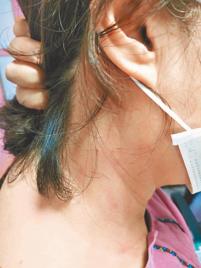 澎湖日前爆發「多人紅疹搔癢」現象，不料近來恆春半島也有多數民眾甚至是遊客出現紅疹發癢狀況。（民眾提供／謝佳潾屏東傳真）