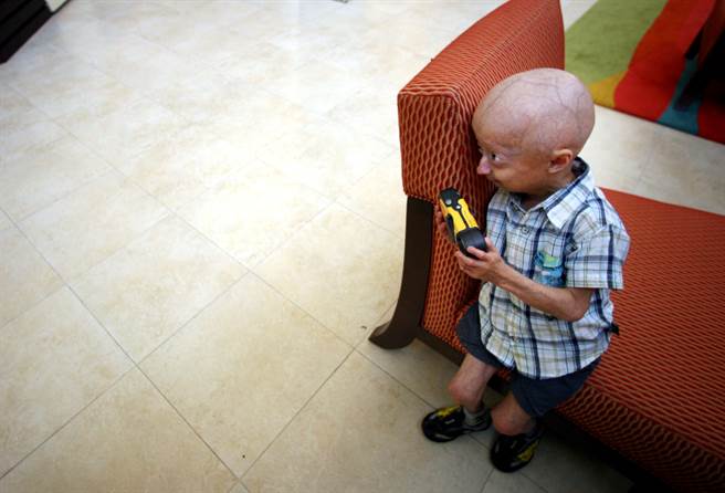 早衰症除了皮膚明顯皺紋外，心血管疾病與骨質疏鬆症也隨之出現，頭部也顯得異常碩大。圖為德國1名罹患早衰症的孩童。(圖/美聯社)