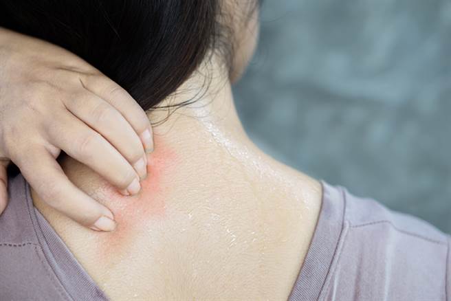 女子背上痘痘竟然鑽出一隻活蛆，嚇得她情緒崩潰。（示意圖／達志影像）