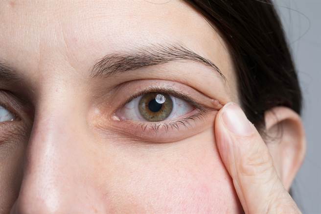 傳說如果長了針眼，用手拉眼角會好得比較快，真有其事嗎？醫師詳細解說。（示意圖／Shutterstock)  