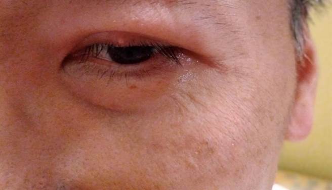麥粒腫是一種平常人眼皮都可能發生的眼皮腺體的炎症，俗稱針眼。(圖/梁惠明攝)
