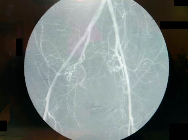 周志恒主任表示，透过放射线仪器，可清楚呈现骨盆腔血管，让医师执行血管栓塞，帮助产后大出血的产妇及时止血。（大千医院提供／谢明俊苗栗传真）