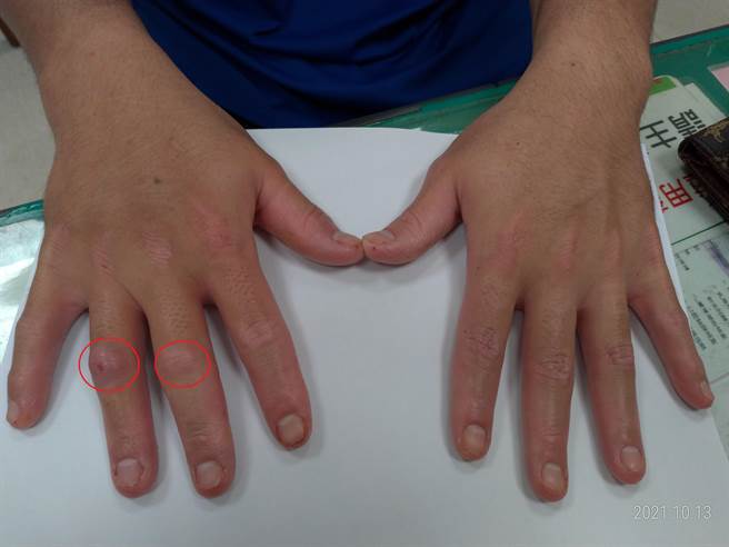 患者罹患乾癣性关节炎，除皮肤症状外，双手关节都会感到僵硬和紧绷，甚至出现「香肠指（趾）」情况。（台中医院提供／张妍溱台中传真）